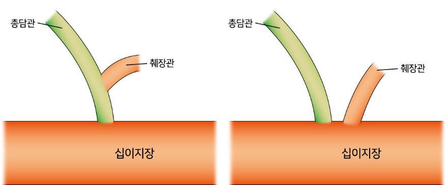 담낭적출02.JPG